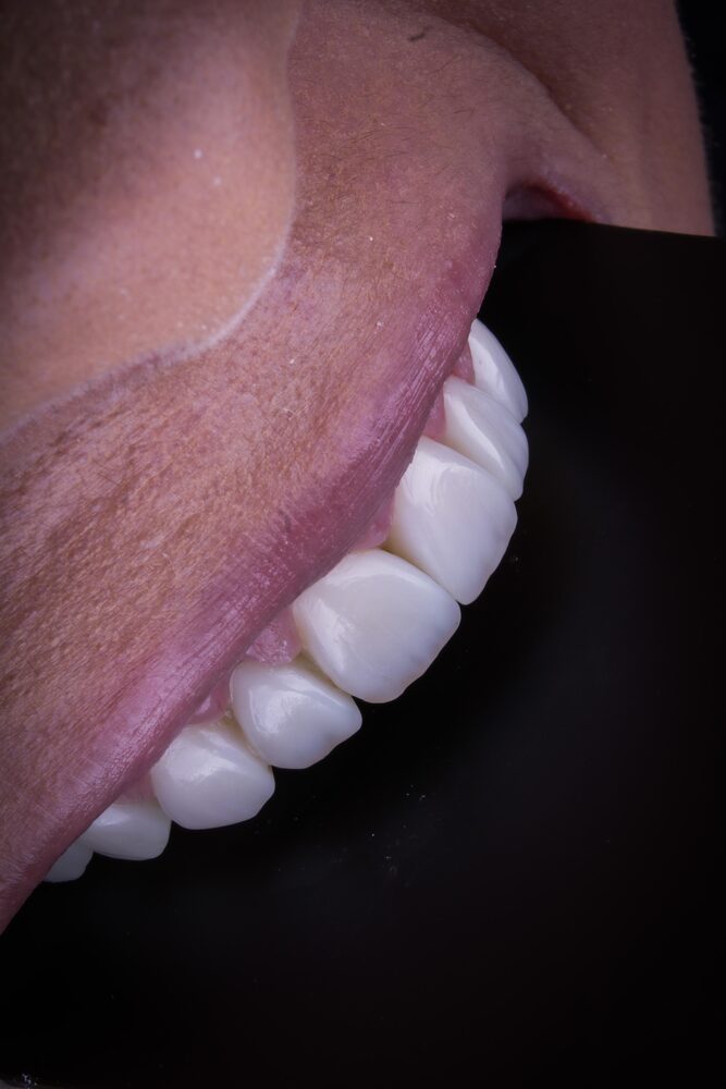 Perfil de sorriso com facetas em resina — caso da Dra. Delci