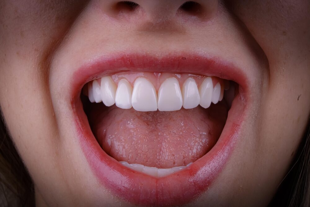 Sorriso feminino com facetas em resina — caso da Dra. Delci